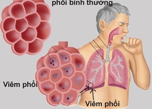 Bạn biết gì về bệnh viêm phổi?