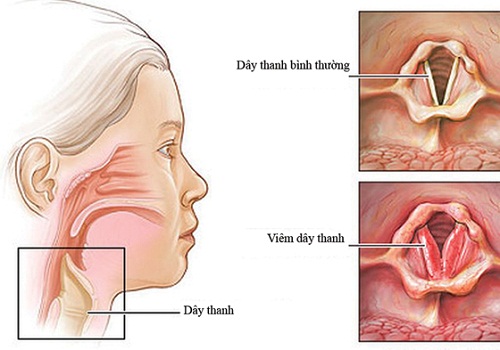 Bạn biết gì về bệnh viêm thanh quản?