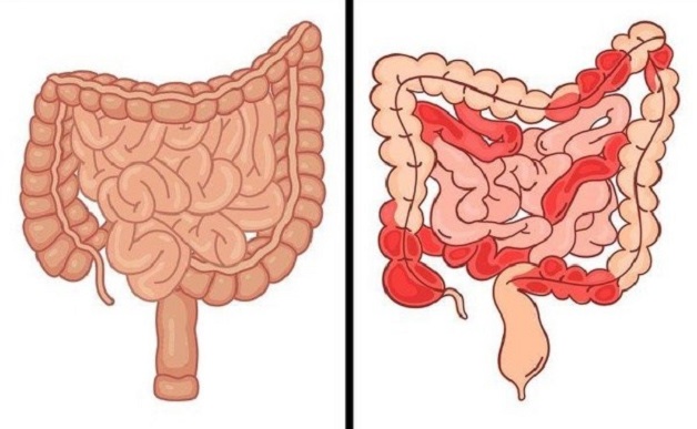 Bạn đã biết gì về loét ruột non