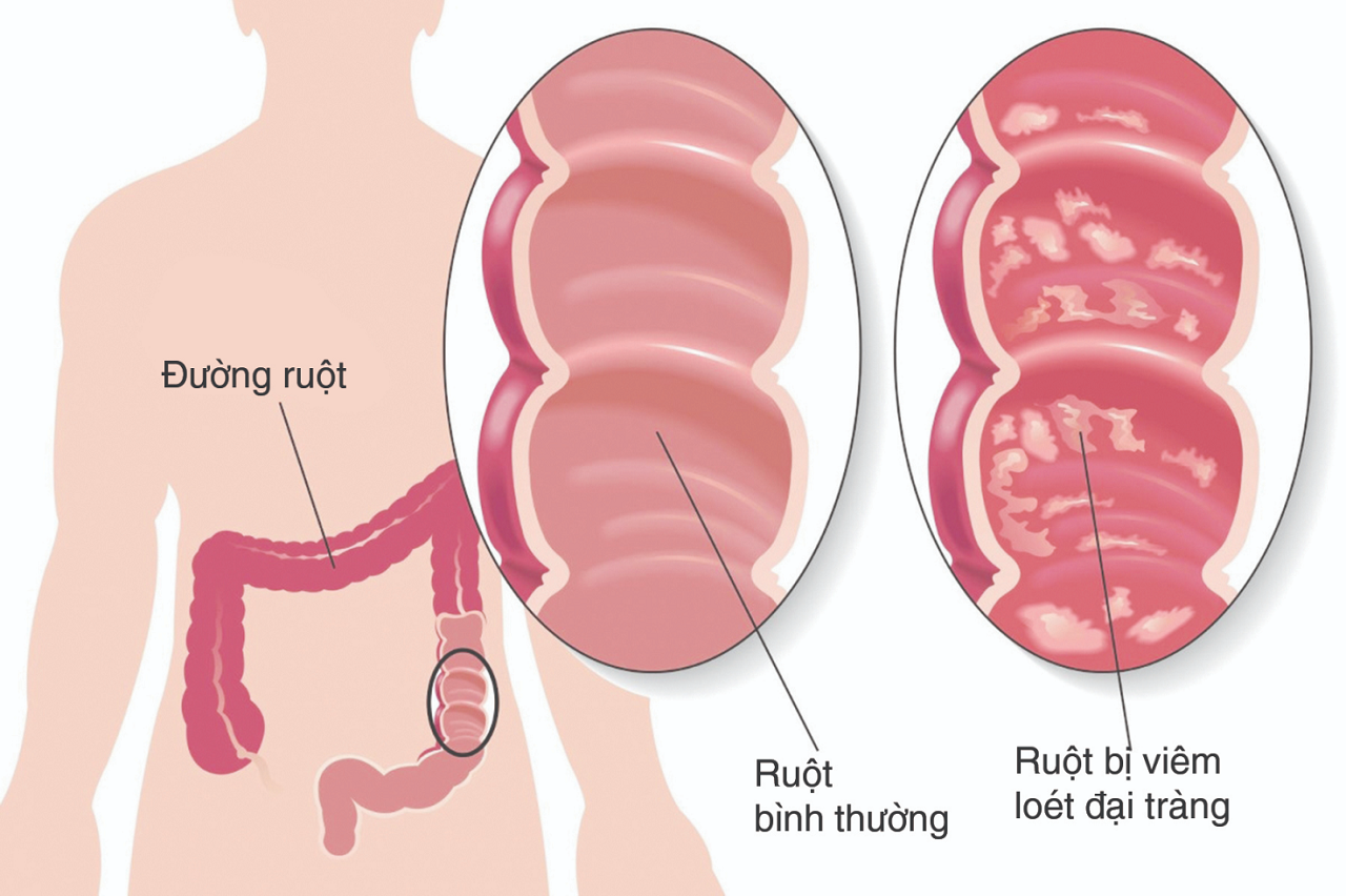 Bạn đã biết gì về viêm đại tràng mạn tính ? 