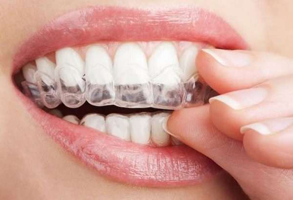 Bạn đã hiểu hết về Niềng răng bằng phương pháp Invisalign