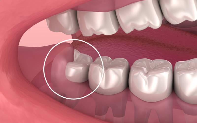 Bảng giá nhổ răng khôn – cập nhật mới