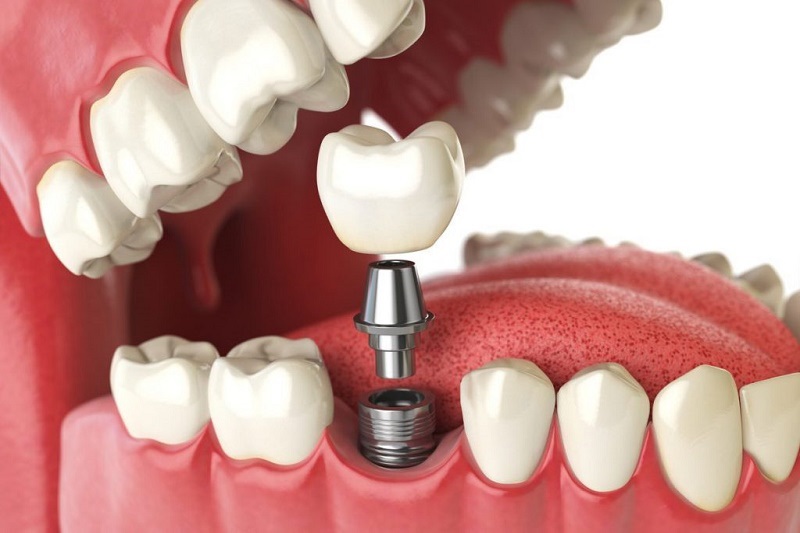 Bảng giá trồng răng Implant: Phân tích chuyên sâu và cập nhật