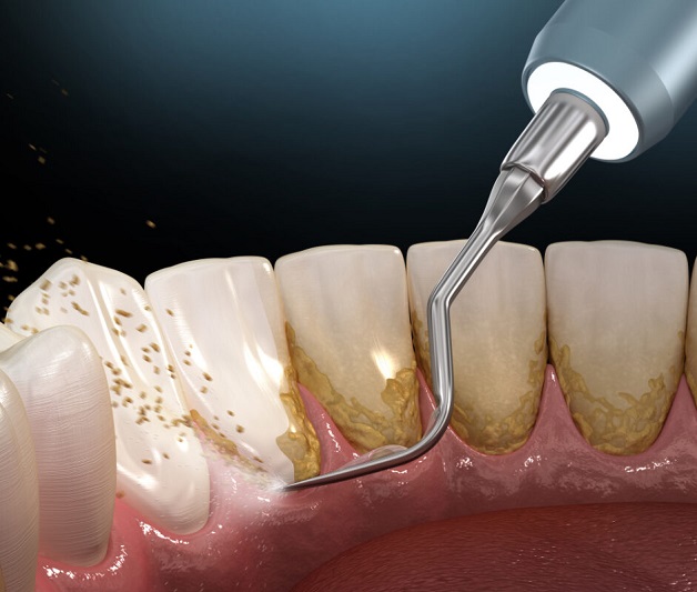 Bao lâu lấy cao răng 1 lần? Tác dụng việc lấy cao răng 