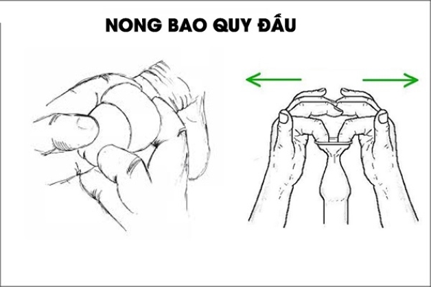 Bao quy đầu hẹp ở người lớn nguy hiểm như thế nào?