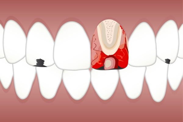 Bảo vệ răng đúng cách để răng không bị sâu