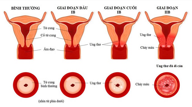 Bảo vệ sức khỏe với tiêm vắc xin ngừa ung thư cổ tử cung