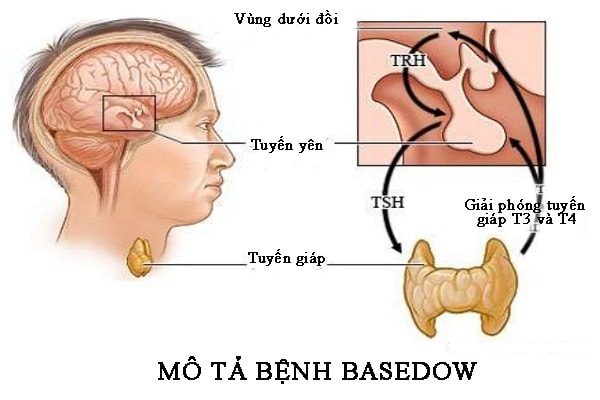 Basedow là bệnh gì? Những điều cần biết cho bệnh nhân