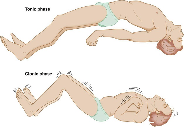 Bật mí các dấu hiệu động kinh theo từng dạng bệnh