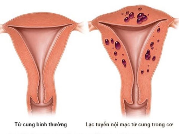 “Bật mí” cách chữa thông tắc vòi trứng hiệu quả, an toàn