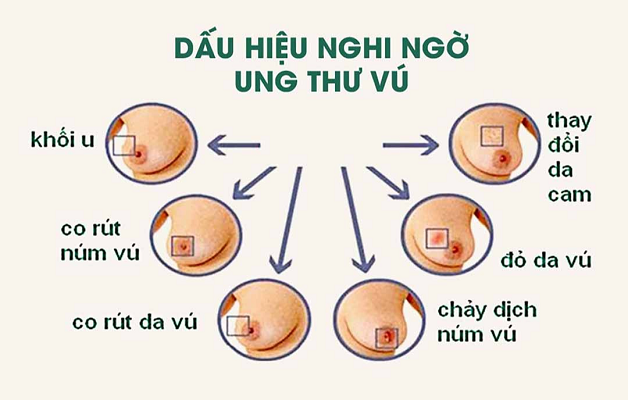 “Bật mí” điều trị ung thư vú ở đâu tốt?