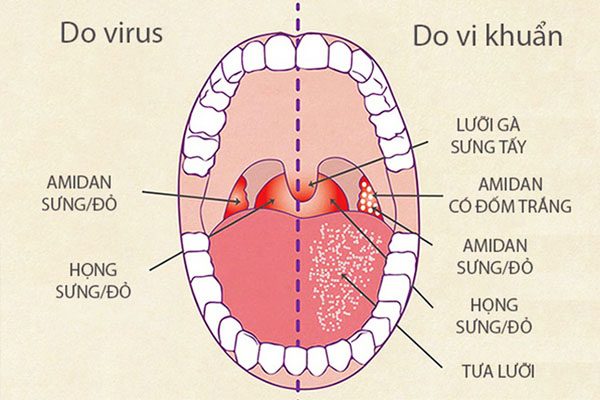 Bé bị viêm họng phải làm sao?kiến thức xử trí