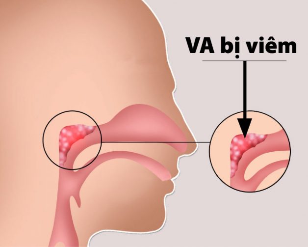 Bé nạo va xong vẫn bị sổ mũi có đáng lo ngại không?