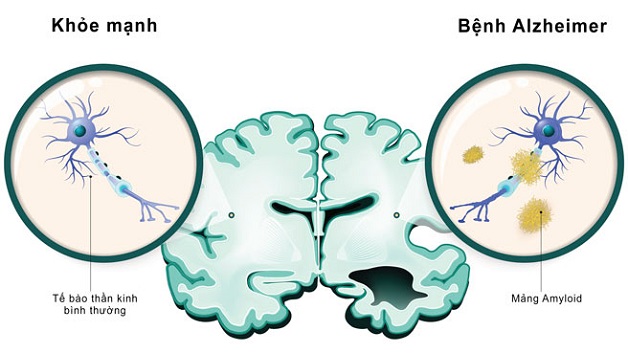 Bệnh alzheimer là gì? Nguyên nhân, triệu chứng, đối tượng