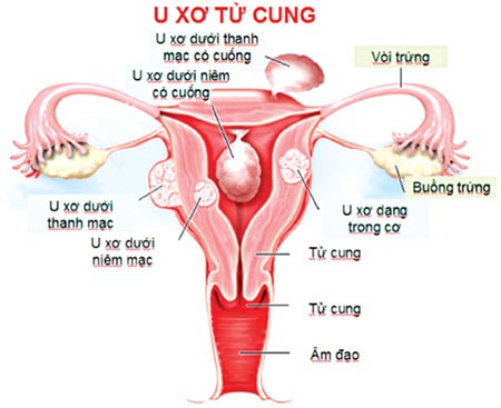 Bệnh án phụ khoa u xơ tử cung