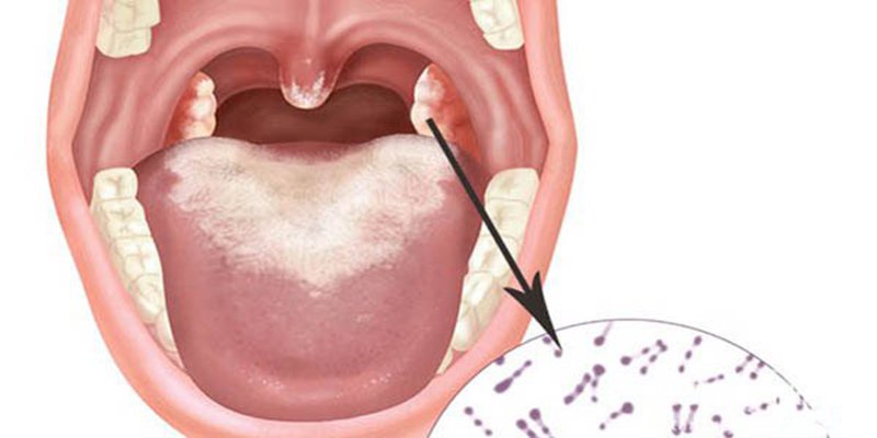 Bệnh bạch bầu: biến chứng và cách phòng ngừa bạn cần biết