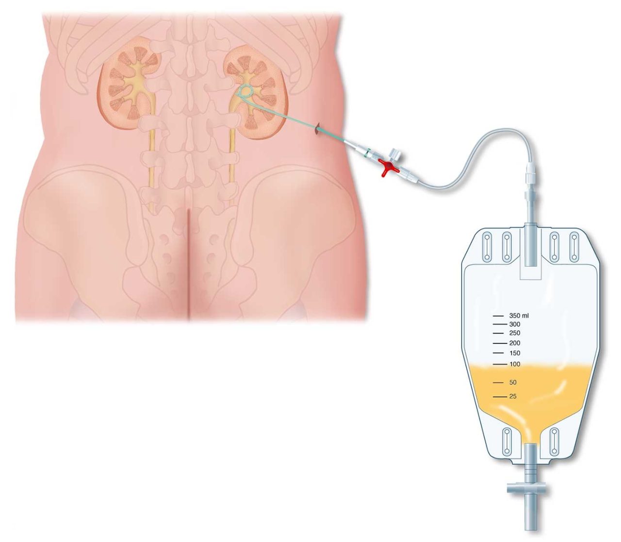 Bệnh chít hẹp niệu quản và phương pháp điều trị