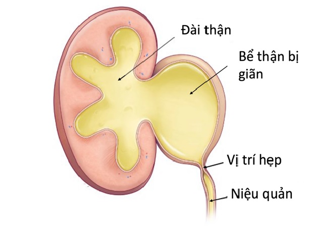 Bệnh chít hẹp niệu quản và phương pháp điều trị