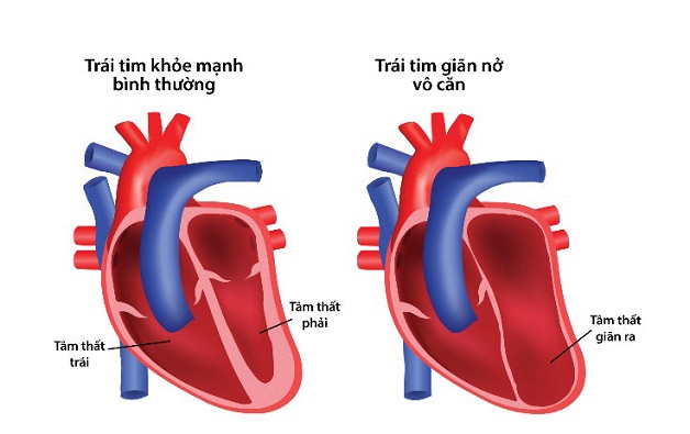 Bệnh cơ tim giãn: Nguyên nhân, triệu chứng, điều trị