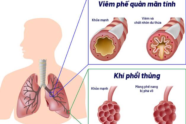 Bệnh COPD và những loại thực phẩm cần lưu ý