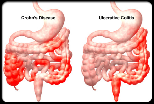 Bệnh Crohn đại tràng