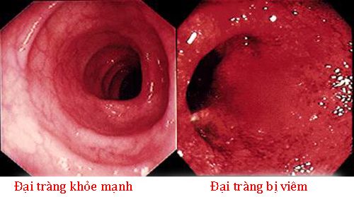 Bệnh Crohn đại tràng