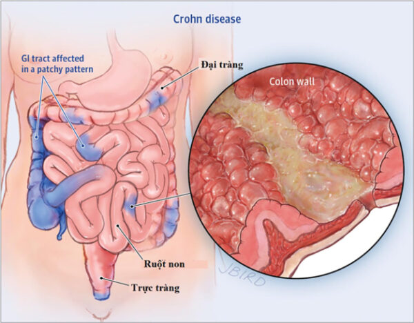 Bệnh Crohn điều trị như thế nào để đạt hiệu quả ?