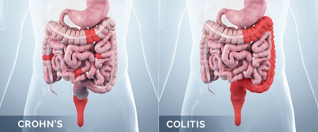 Bệnh Crohn là gì? Cách điều trị và giải pháp phòng bệnh