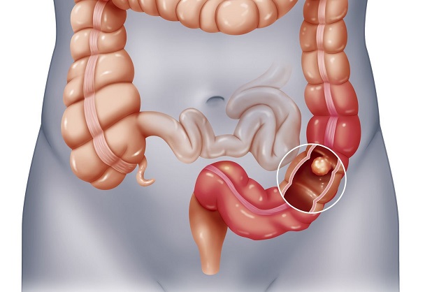 Bệnh crohn là gì? Những kiến thức cần cần biết