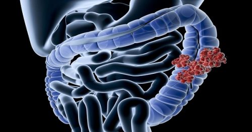 Bệnh Crohn là gì và những dấu hiệu nhận biết bệnh Crohn