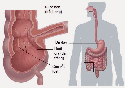 Bệnh Crohn là gì?