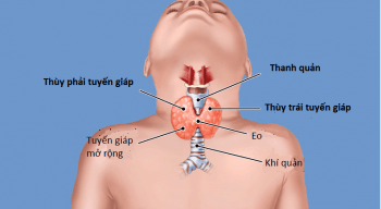 Bệnh cường giáp có chữa khỏi được không?