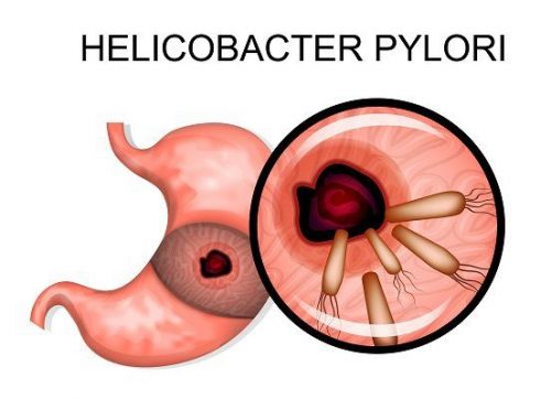 Bệnh dạ dày có chữa được không?