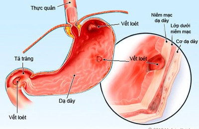 Bệnh dạ dày có lây không và lây qua đường nào?