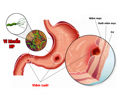 Bệnh dạ dày có nguy hiểm không?