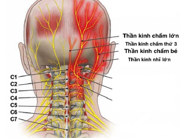 Bệnh đau đầu arnold là gì và những vấn đề liên quan