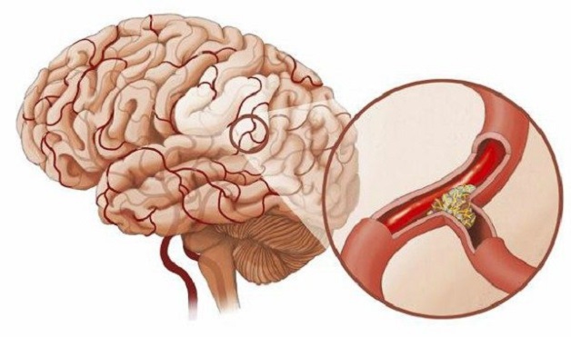 Bệnh đau đầu mạch máu là gì? Nguy hiểm như thế nào?