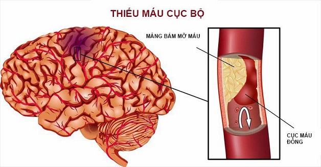 Bệnh đau đầu ở nam giới do những nguyên nhân nào?