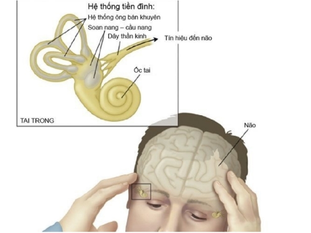 Bệnh đau đầu rối loạn tiền đình có nguy hiểm không, điều trị thế nào?