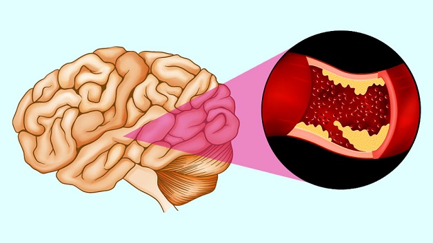 Bệnh đau đầu vận mạch và mối lo đột quỵ não