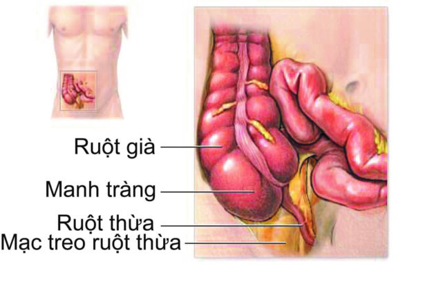 Bệnh đau ruột thừa: Triệu chứng nhận biết 