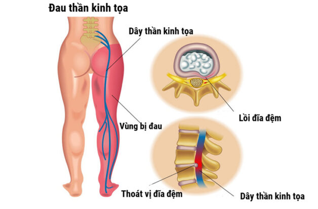 Bệnh đau thần kinh tọa có chữa khỏi không?