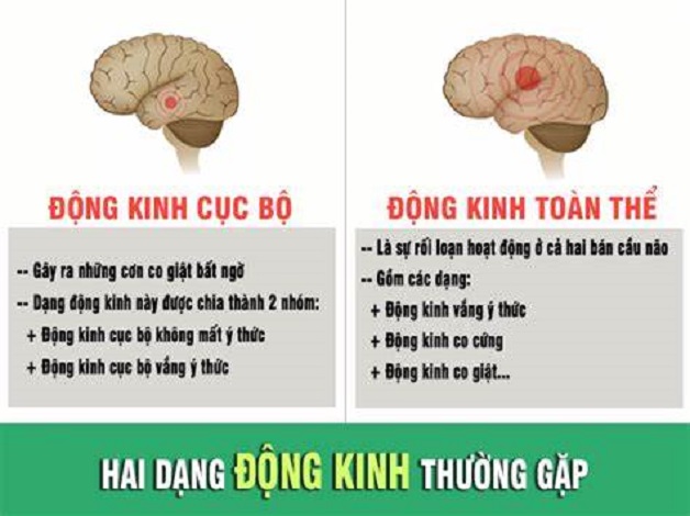 Bệnh động kinh cục bộ: phân loại và biểu hiện