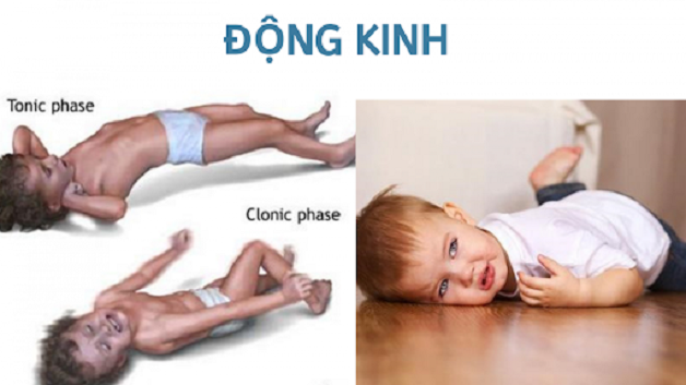 Bệnh động kinh cục bộ: phân loại và biểu hiện