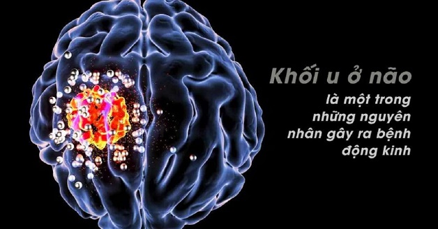 Bệnh động kinh hiểu đúng, điều trị hiệu quả