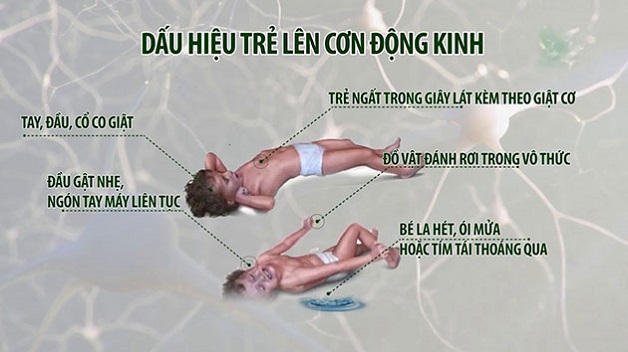 Bệnh động kinh khi ngủ: biểu hiện và chẩn đoán