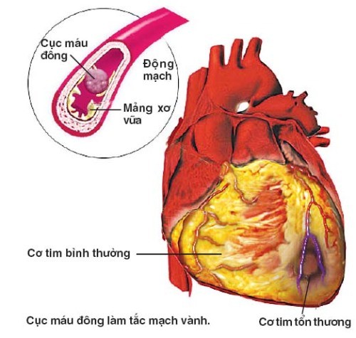 Bệnh động mạch vành là gì? Điều trị ra sao?