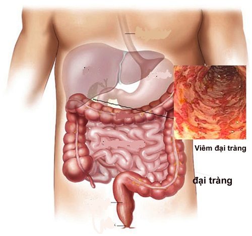 Bệnh đường ruột là gì?