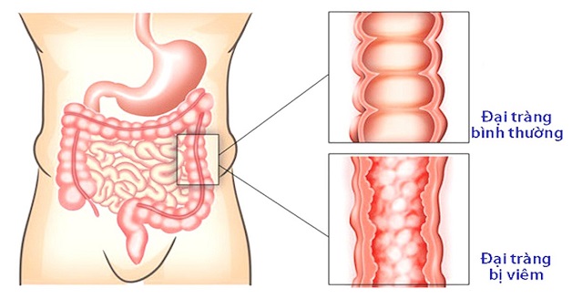 Bệnh đường tiêu hóa là gì? Triệu chứng nguyên nhân gây bệnh