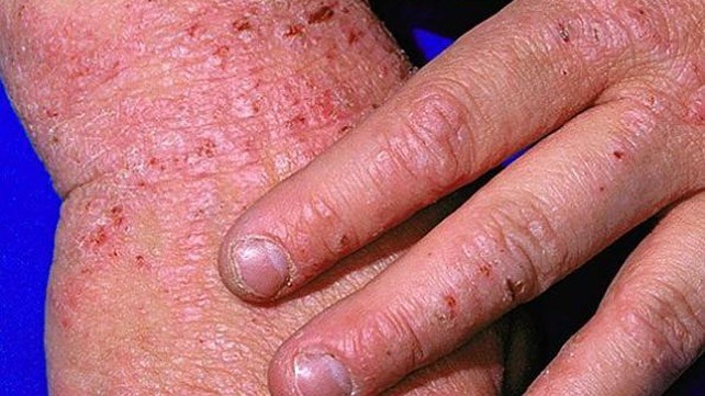 Bệnh eczema có lây không? nỗi ám ảnh của người bệnh